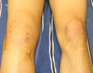 lesion rodilla derrame ligamento cruzado anterior