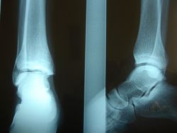 radiografias lesion esguince externo tobillo