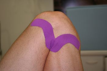 Síndrome de la  Cintilla Iliotibial: Técnica Fascial