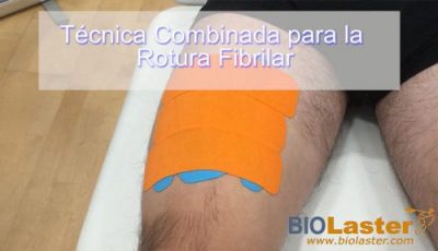 Técnica combinada: técnica fascial con técnica de aumento de espacio para la Rotura Fibrilar