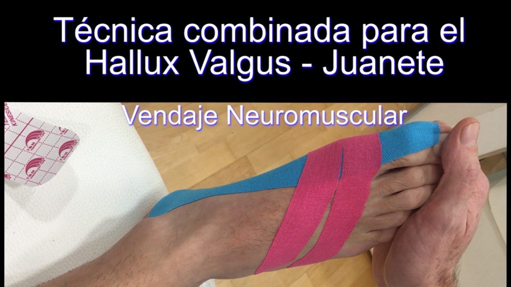 Hallux Valgus Técnica muscular junto a técnica fascial Kinesiology Tape