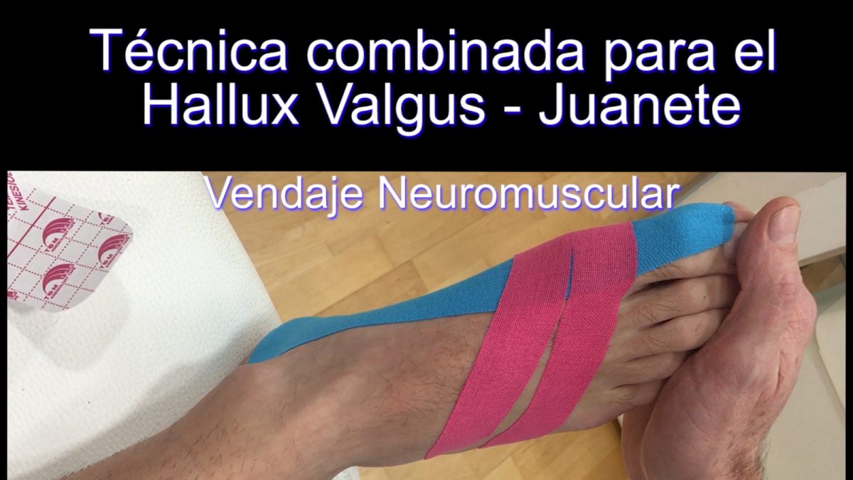 Hallux Valgus: Técnica muscular junto a técnica fascial