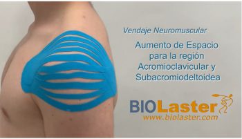 Caso clínico: Esguince acromioclavicular.