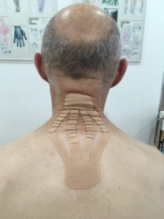 Técnica linfática cervical: Variante