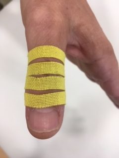 Desaparecer granizo Mendicidad Capsulitis interfalángica distal del primer dedo: variante con técnica de  espacio-corrección mecánica. - Kinesiology Tape