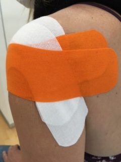 Facilitación de la abducción del hombro: técnica de corrección mecánica con vendaje neuromuscular.