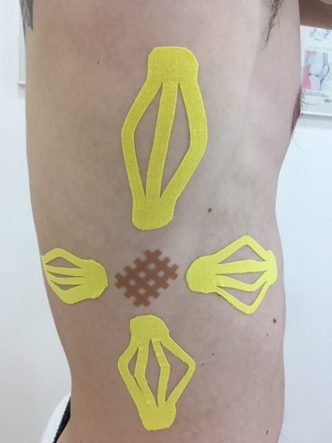 Traumatismo costal: Cross Tape con vendaje neuromuscular.