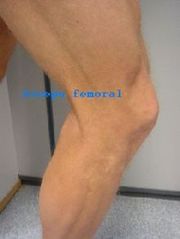 rodilla biceps femoral tendinitis