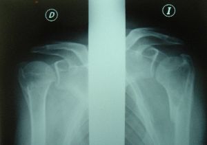 fractura bilateral clavicula ciclismo lesion traumatismo