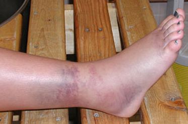 Esguinces de Tobillo en Biolaster
