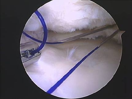 Sutura Meniscal