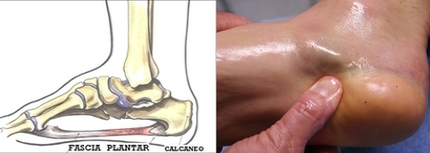 Fascitis Plantar