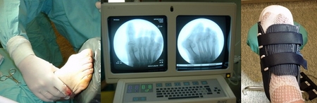 Hallux Valgus (Juanetes) en el Blog de Trauma de Biolaster