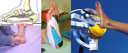 Fases Temporales del Tratamiento Medico de la Fascitis Plantar