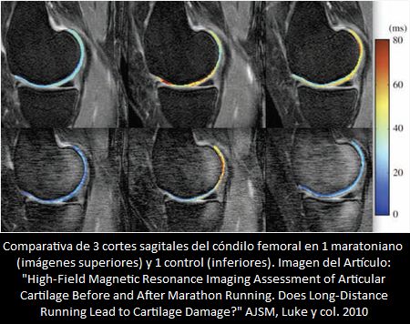 La Carrera de Larga Distancia Tiende a Deteriorar el Cartilago? Control mediante Resonancia Magnetica del Cartilago Articular de la Rodilla, Antes y Despues de una Carrera de Marathon.