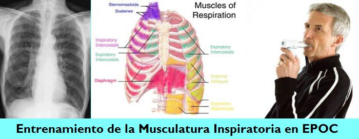 El Entrenamiento de la Musculatura Inspiratoria para pacientes con Enfermedad Pulmonar Obstructiva Crnica (EPOC): Gua Prctica para Mdicos