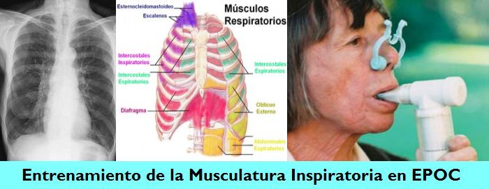 Entrenamiento Muscular Inspiratorio (EMI) en el Paciente con Enfermedad Pulmonar Obstructiva Crónica (EPOC)
