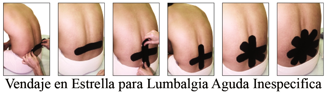 Efecto de la Aplicación del Kinesiotaping en la Lumbalgia Aguda Inespecifica