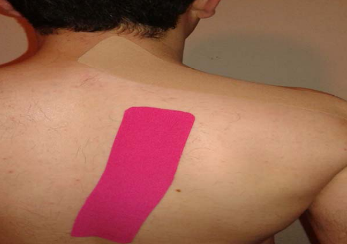 Efecto del Kinesiotaping de Trapecio en dolor, movilidad funcional del hombro y deslizamiento lateral escapular en atletas con síndrome de compresión