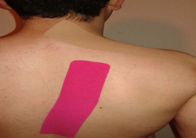 Efecto del Kinesiotaping de Trapecio en dolor, movilidad funcional del hombro y deslizamiento lateral escapular en atletas con sndrome de compresin