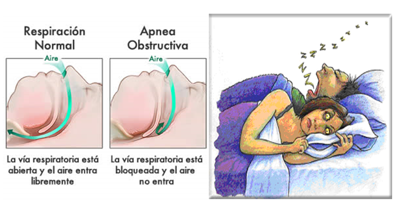 Impacto de la Apnea Obstructiva del Sueño en Pacientes con Hígado Graso y Obesidad Severa
