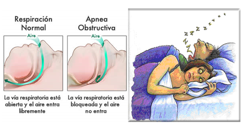 Barricada Están familiarizados petróleo crudo Impacto de la Apnea Obstructiva del Sueño en Pacientes con Hígado Graso y  Obesidad Severa. Biolaster