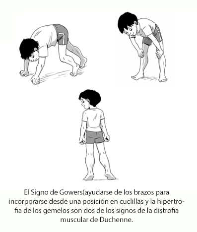 El entrenamiento muscular inspiratorio ayuda a las personas con distrofia muscular