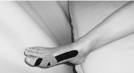 Mejora del Hallux Valgus o juanete con el kinesiotaping