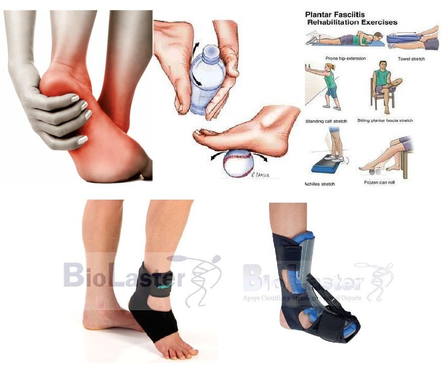 Fascitis plantar: qué es, sintomatología y tratamiento