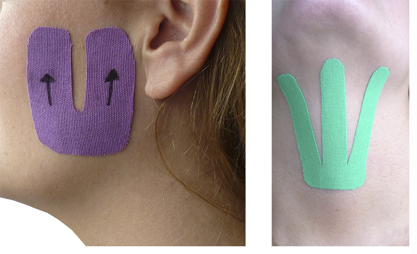 Aplicación del Kinesiotaping en Logopedia