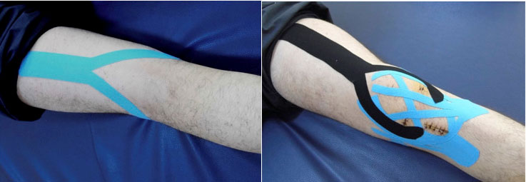 Aplicación del kinesiotaping en la fase aguda postquirúrgica de reconstruccion del ligamento cruzado anterior de la rodilla