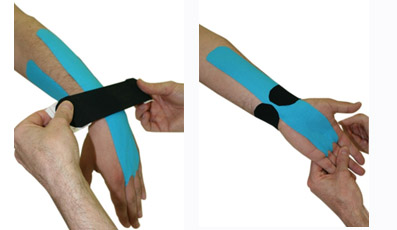 Kinesiotaping en el Sndrome del Tnel Carpiano