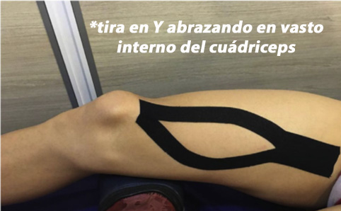 Beneficios del kinesiotaping en el Síndrome de Dolor Patelofemoral en el dolor y la funcionalidad de rodilla.