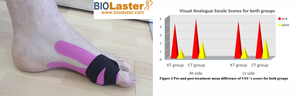 Kinesiotape y Sport Tape dos posible vas de tratamiento del Hallux Valgus