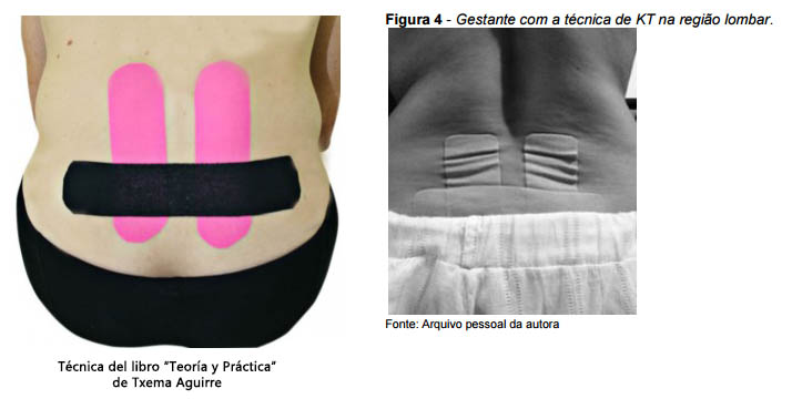 Kinesiotaping e hidroterapia aplicada en embarazadas con dolor plvico posterior