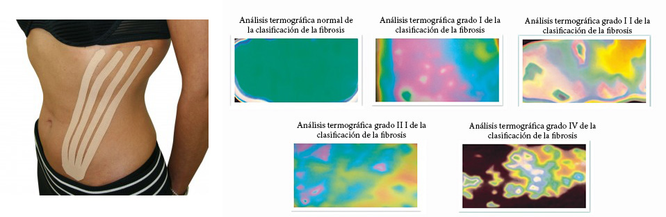 Kinesiotaping aplicado en la fase posoperatoria de la ciruga plstica en el abdomen