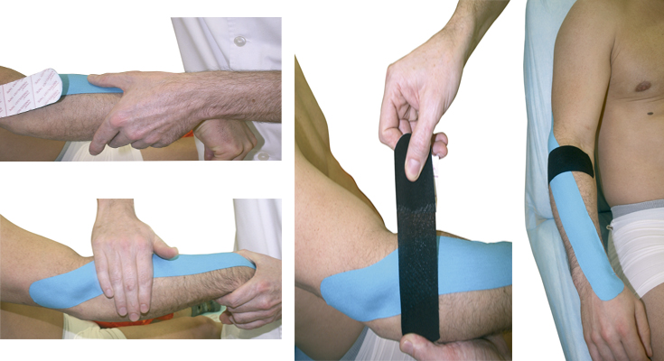 Kinesiotaping aplicado en la  epicondilitis