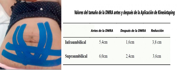 Vendaje Kinesiotaping Aplicado en la Diástasis Abdominal en el Postparto