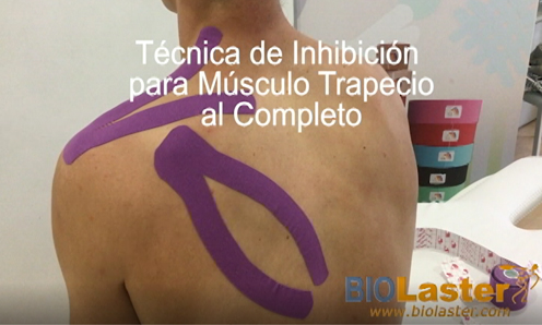 Tcnica del Msculo Trapecio al Completo