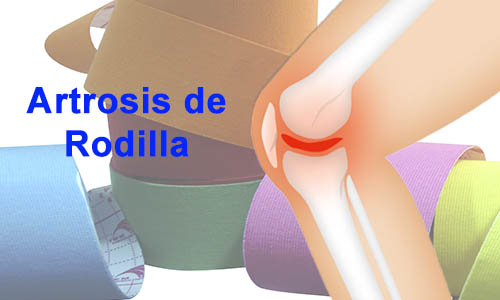 Beneficios a corto plazo de la Aplicacin del Kinesiotaping en la Rodilla Artrosica