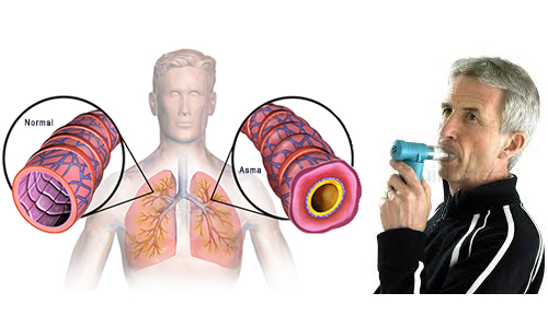 Asma, bronquitis, insuficiencia respiratoria disminuyen sus síntomas con el POWERbreathe