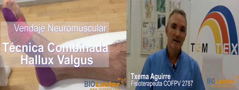 Video: Técnica combinada para el Hallux Valgus (Juanete)