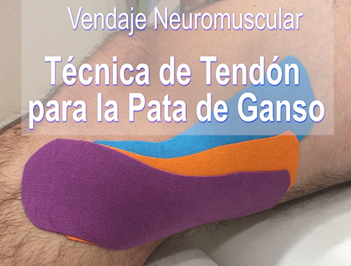 Tratamiento de la Pata de Ganso Mediante Vendaje Neuromuscular