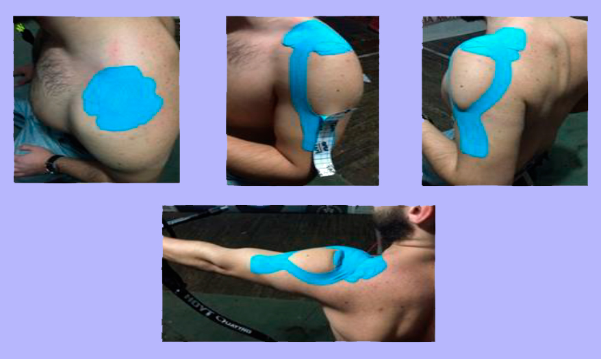 Aplicación de Kinesiotaping en la mejora de resultados en el Tiro con Arco