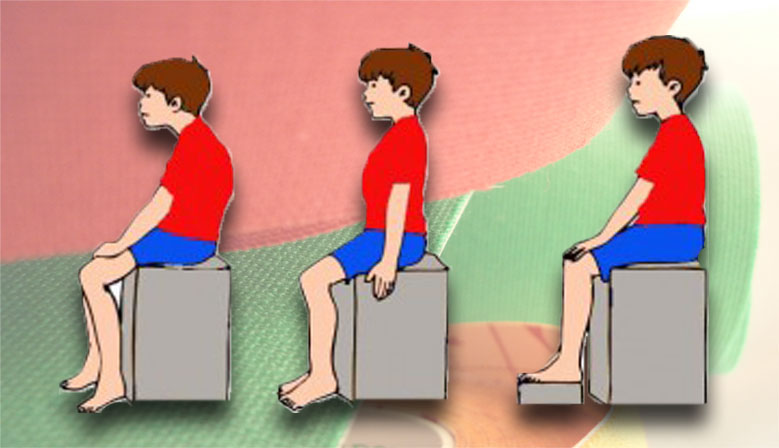 Accin del Kinesiotaping sobre la postura en nios con parlisis cerebral