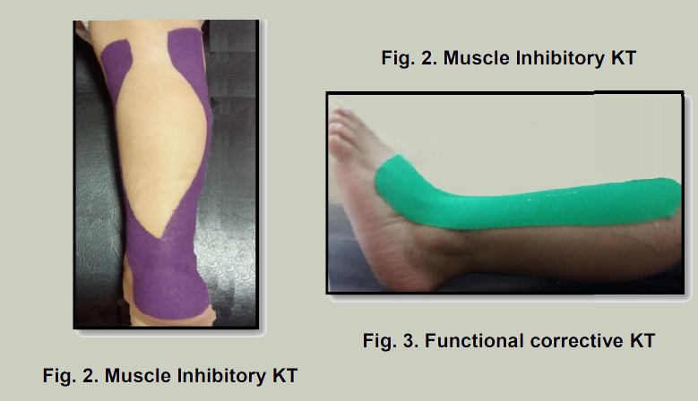Kinesiotaping aplicado en el tobillo espástico de niños con parálisis cerebral. Estudio comparativo