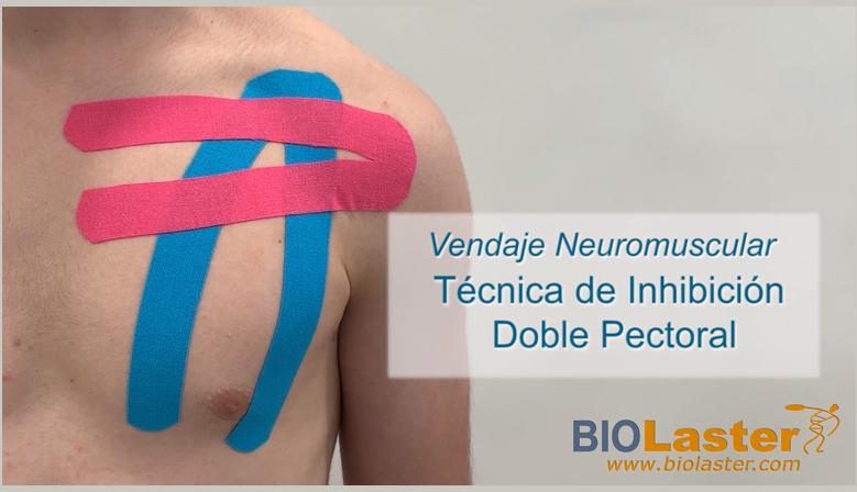 Vídeo: Aplicación de Vendaje Neuromuscular en el Pectoral