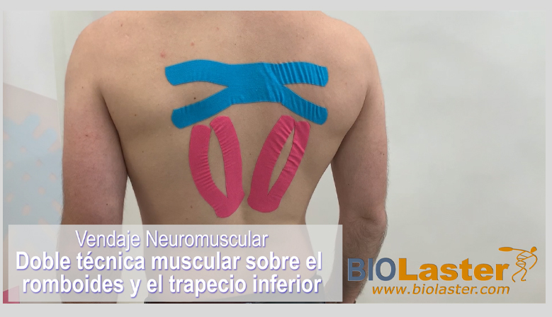 Vdeo: Doble Tcnica Muscular sobre el Romboides y el Trapecio Inferior