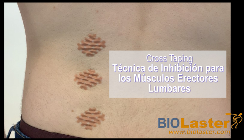 Aplicación de Cross Taping en la Zona Lumbar