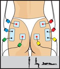 electroestimulacion COMPEX One entrenamiento musculatura rehabilitacion fuerza posicin electrodos marcar abdominales